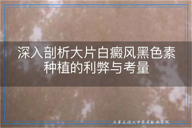 深入剖析大片白癜风黑色素种植的利弊与考量