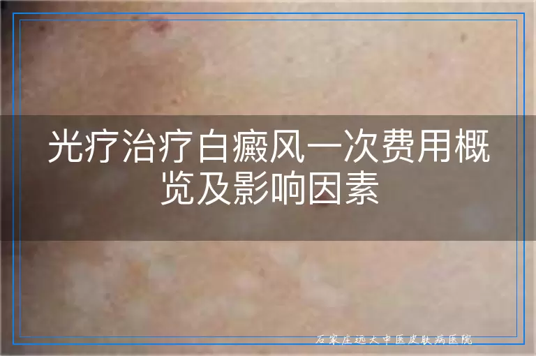 光疗治疗白癜风一次费用概览及影响因素