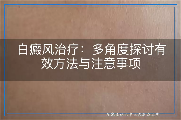 白癜风治疗：多角度探讨有效方法与注意事项