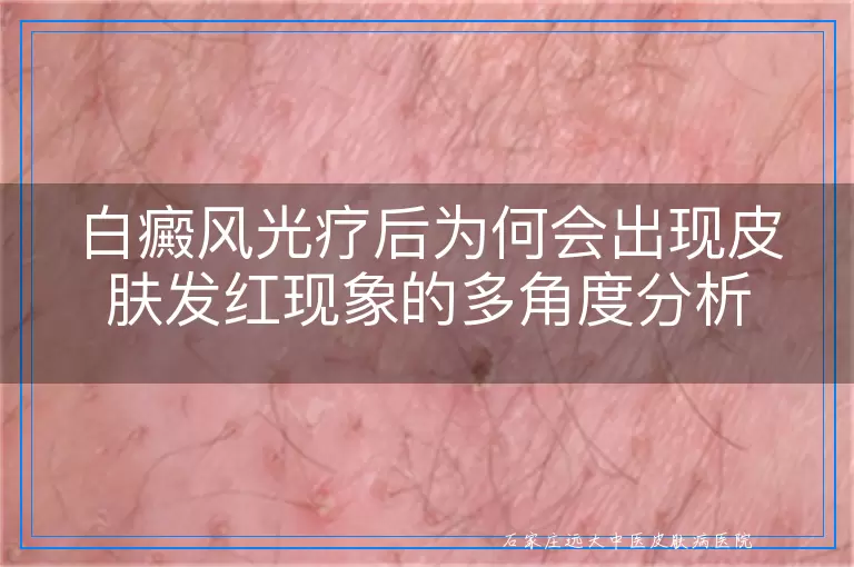 白癜风光疗后为何会出现皮肤发红现象的多角度分析