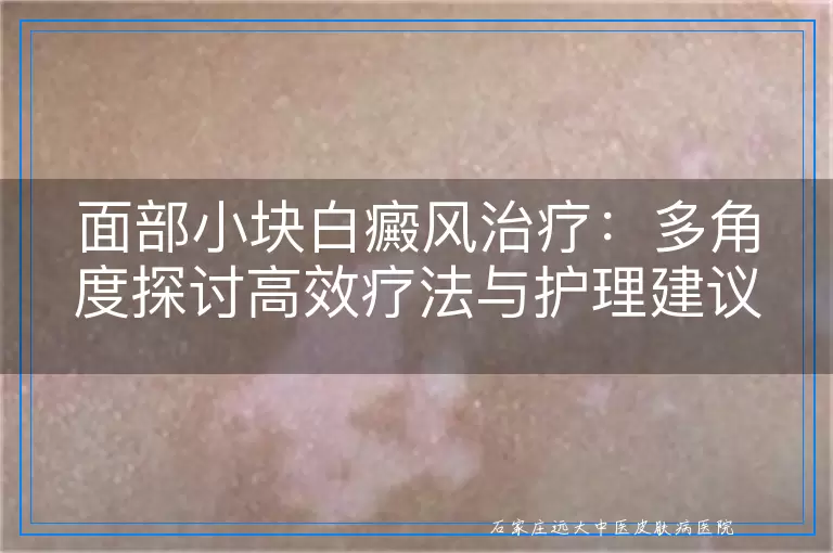 面部小块白癜风治疗：多角度探讨高效疗法与护理建议