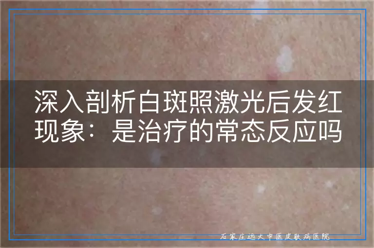 深入剖析白斑照激光后发红现象：是治疗的常态反应吗？