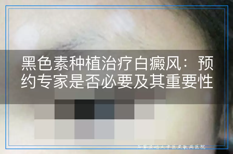 黑色素种植治疗白癜风：预约专家是否必要及其重要性探讨