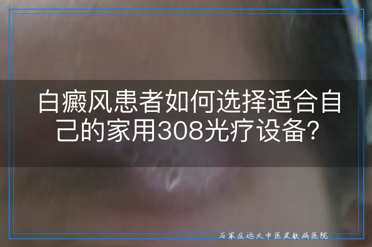 白癜风患者如何选择适合自己的家用308光疗设备？