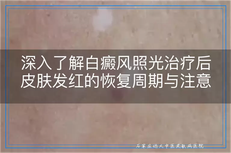 深入了解白癜风照光治疗后皮肤发红的恢复周期与注意事项