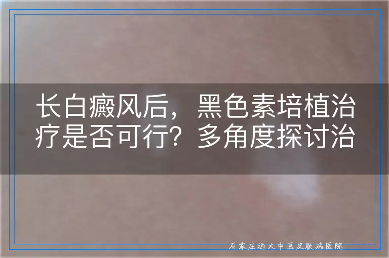 长白癜风后，黑色素培植治疗是否可行？多角度探讨治疗选择