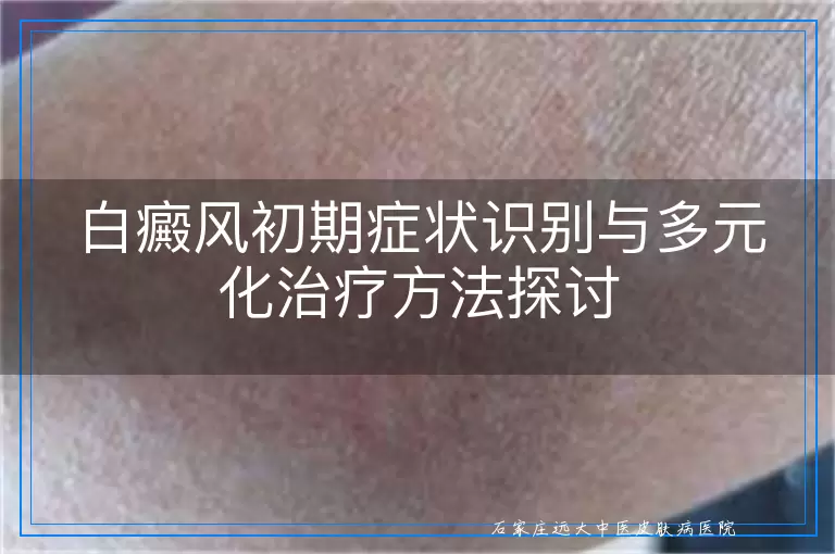 白癜风初期症状识别与多元化治疗方法探讨