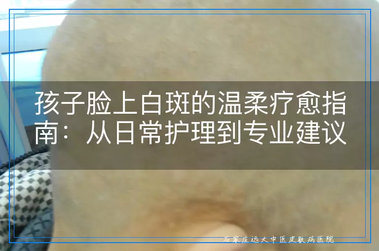孩子脸上白斑的温柔疗愈指南：从日常护理到专业建议