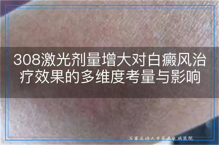 308激光剂量增大对白癜风治疗效果的多维度考量与影响分析
