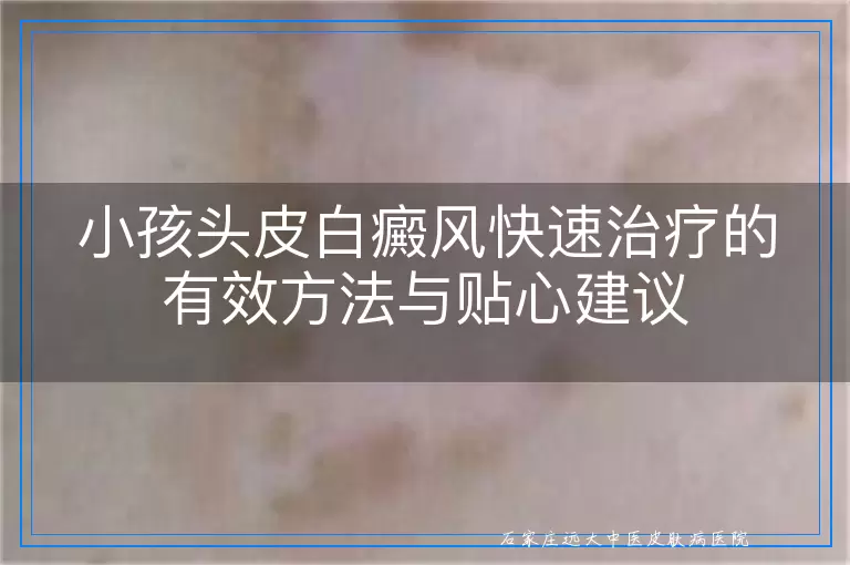 小孩头皮白癜风快速治疗的有效方法与贴心建议