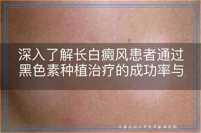 深入了解长白癜风患者通过黑色素种植治疗的成功率与实际案例
