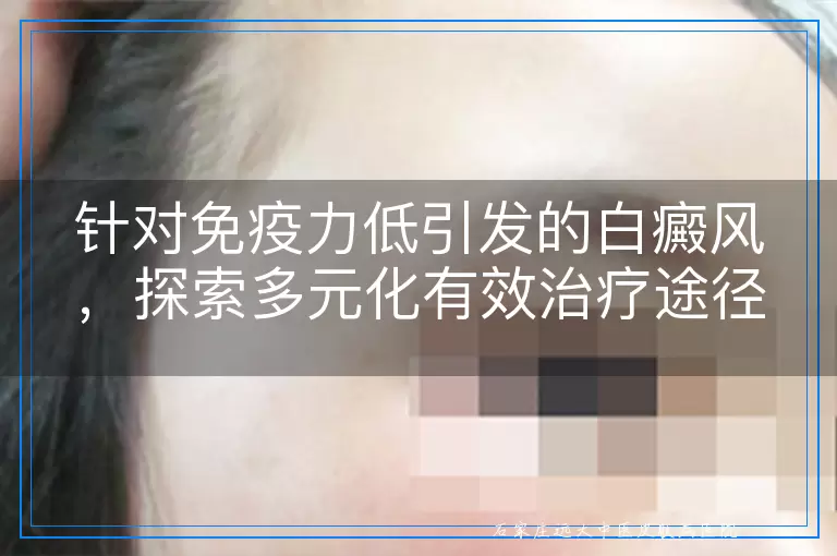 针对免疫力低引发的白癜风，探索多元化有效治疗途径