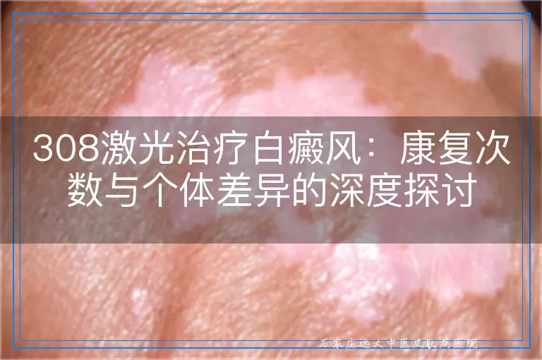 308激光治疗白癜风：康复次数与个体差异的深度探讨