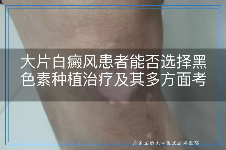 大片白癜风患者能否选择黑色素种植治疗及其多方面考量