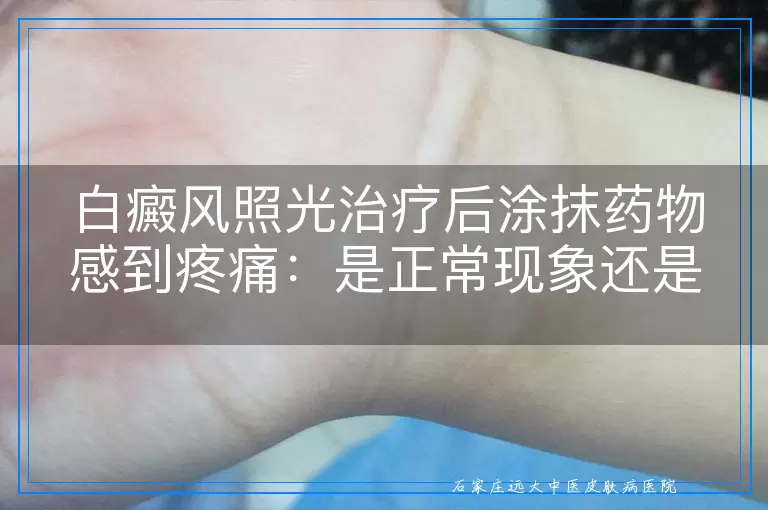白癜风照光治疗后涂抹药物感到疼痛：是正常现象还是需关注的情况？