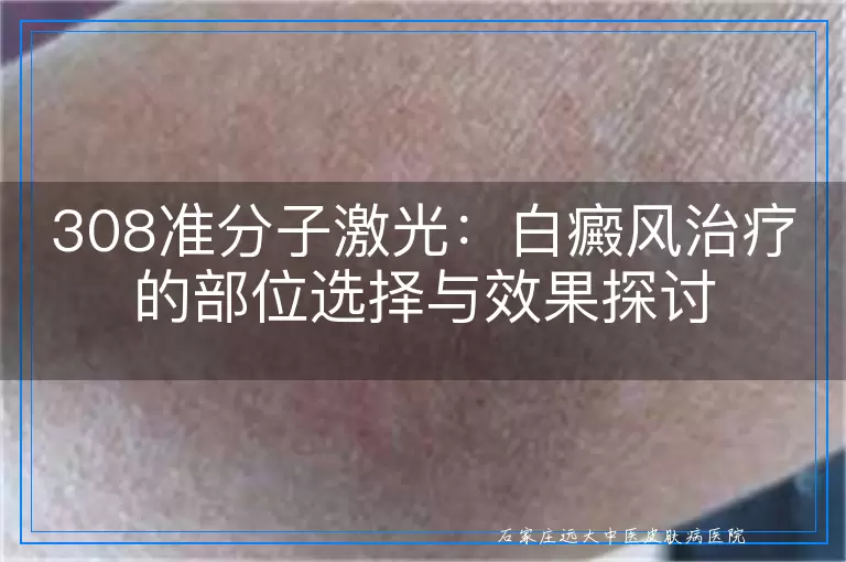 308准分子激光：白癜风治疗的部位选择与效果探讨