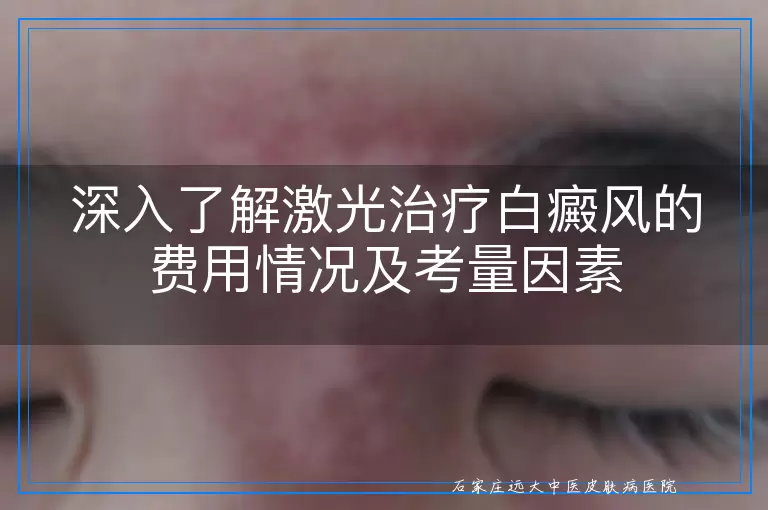 深入了解激光治疗白癜风的费用情况及考量因素