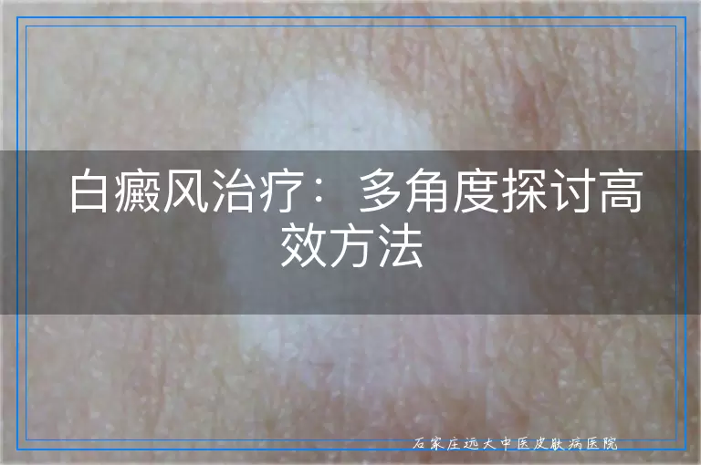 白癜风治疗：多角度探讨高效方法