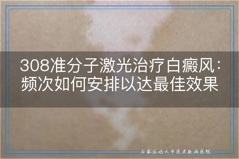 308准分子激光治疗白癜风：频次如何安排以达最佳效果？