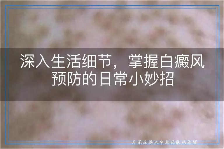 深入生活细节，掌握白癜风预防的日常小妙招