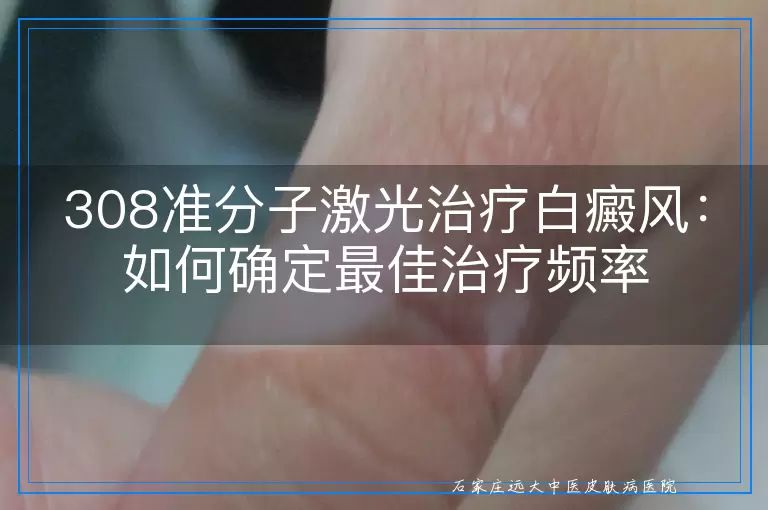 308准分子激光治疗白癜风：如何确定最佳治疗频率