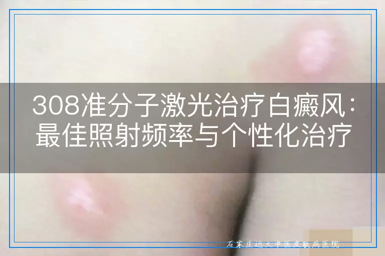 308准分子激光治疗白癜风：最佳照射频率与个性化治疗方案