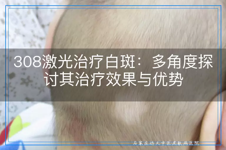 308激光治疗白斑：多角度探讨其治疗效果与优势