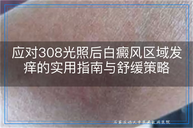 应对308光照后白癜风区域发痒的实用指南与舒缓策略