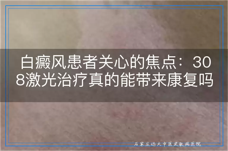 白癜风患者关心的焦点：308激光治疗真的能带来康复吗？