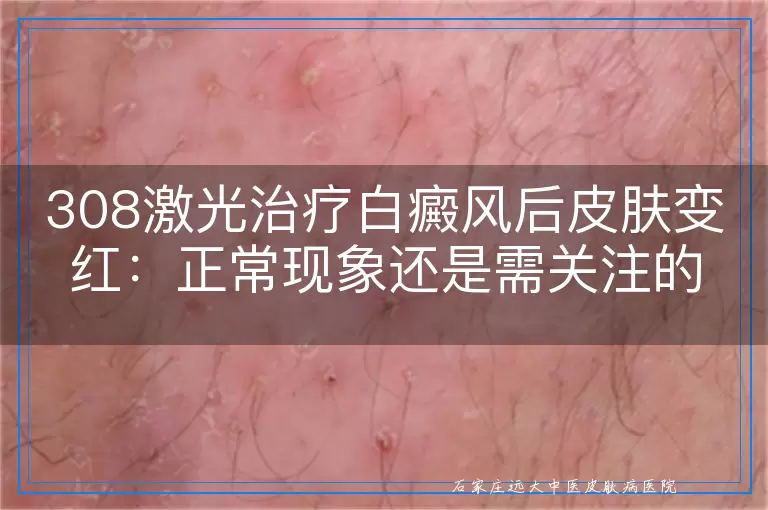 308激光治疗白癜风后皮肤变红：正常现象还是需关注的信号？