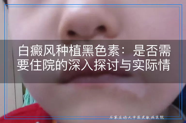 白癜风种植黑色素：是否需要住院的深入探讨与实际情况
