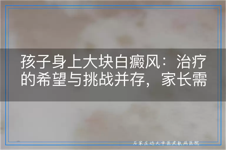 孩子身上大块白癜风：治疗的希望与挑战并存，家长需知的真实情况