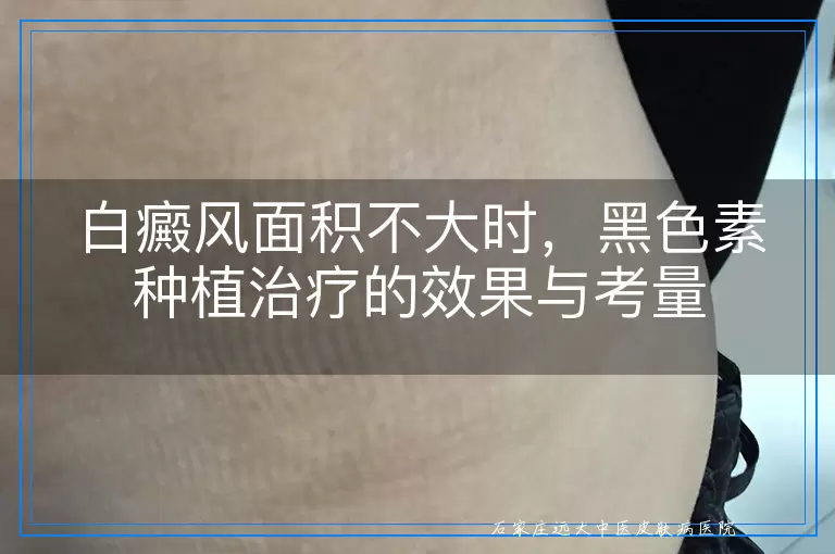 白癜风面积不大时，黑色素种植治疗的效果与考量