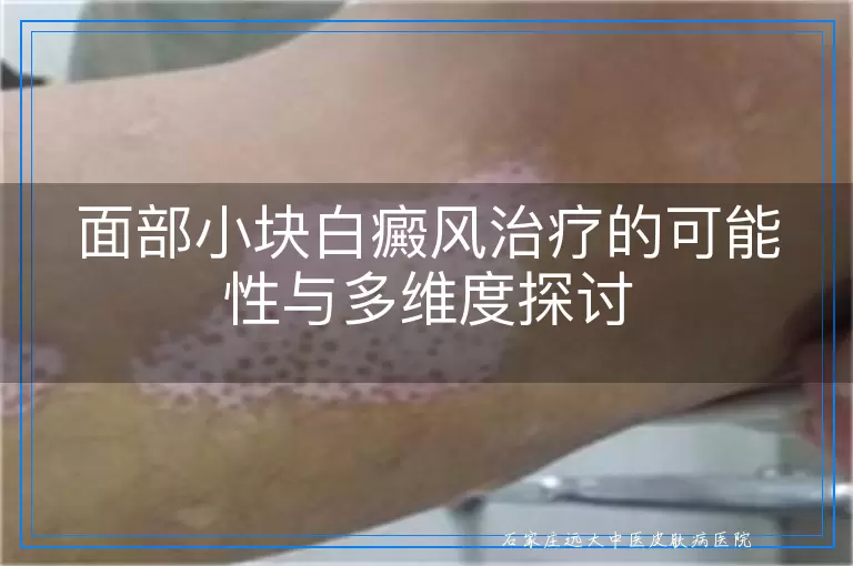 面部小块白癜风治疗的可能性与多维度探讨