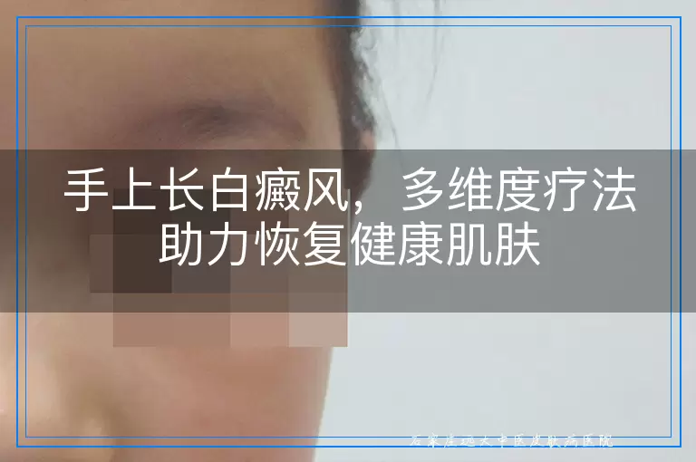 手上长白癜风，多维度疗法助力恢复健康肌肤