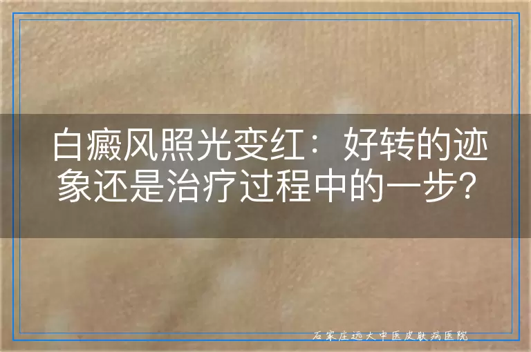 白癜风照光变红：好转的迹象还是治疗过程中的一步？
