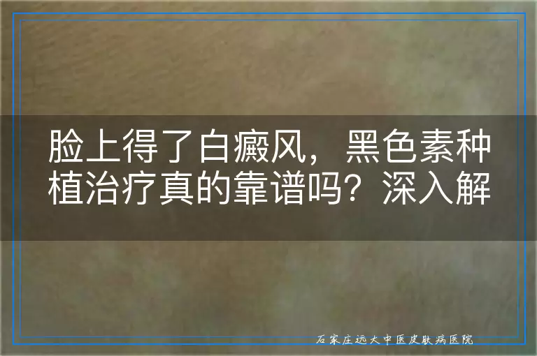 脸上得了白癜风，黑色素种植治疗真的靠谱吗？深入解读其效果与考量