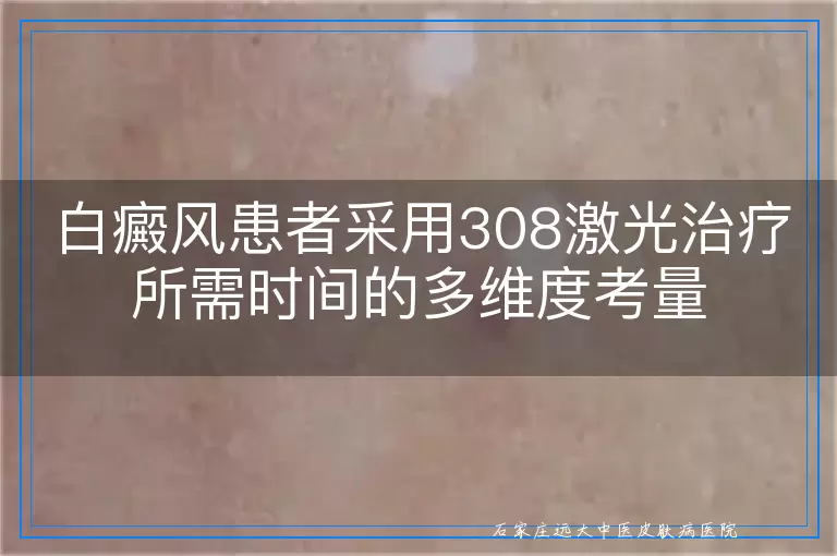 白癜风患者采用308激光治疗所需时间的多维度考量