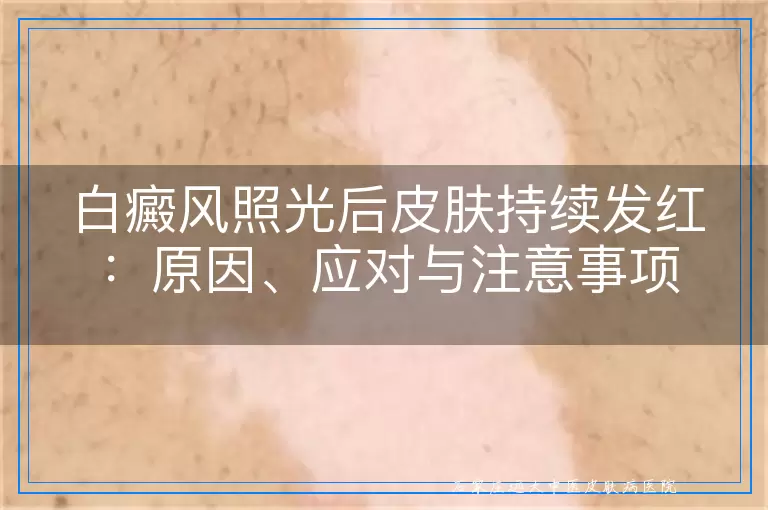 白癜风照光后皮肤持续发红：原因、应对与注意事项