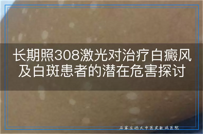 长期照308激光对治疗白癜风及白斑患者的潜在危害探讨
