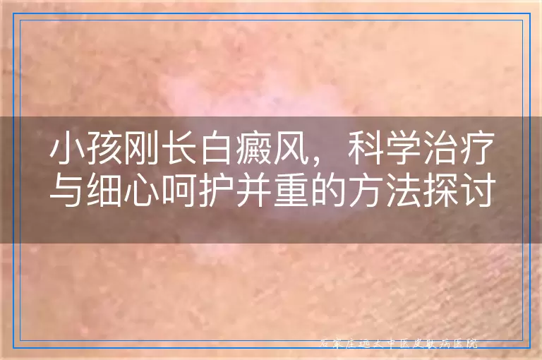 小孩刚长白癜风，科学治疗与细心呵护并重的方法探讨