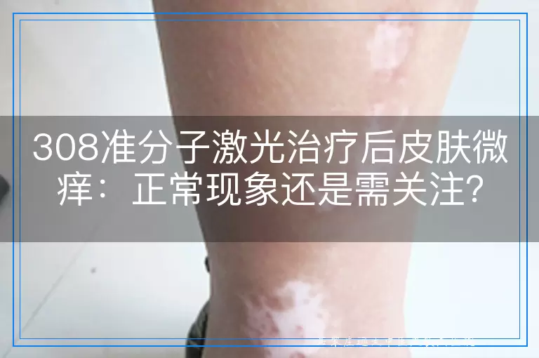 308准分子激光治疗后皮肤微痒：正常现象还是需关注？