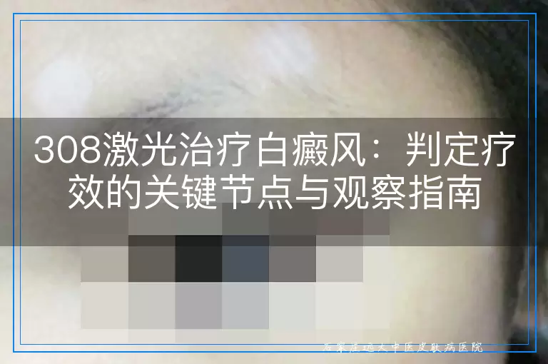 308激光治疗白癜风：判定疗效的关键节点与观察指南