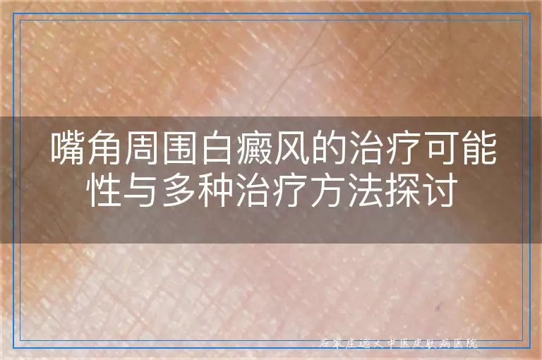 嘴角周围白癜风的治疗可能性与多种治疗方法探讨