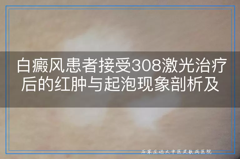 白癜风患者接受308激光治疗后的红肿与起泡现象剖析及应对