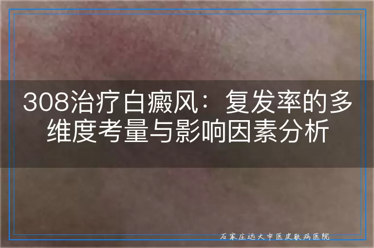 308治疗白癜风：复发率的多维度考量与影响因素分析