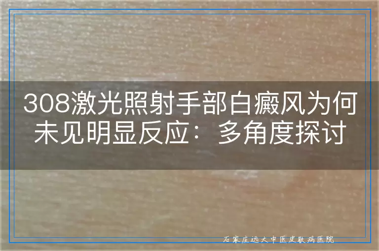 308激光照射手部白癜风为何未见明显反应：多角度探讨与应对策略