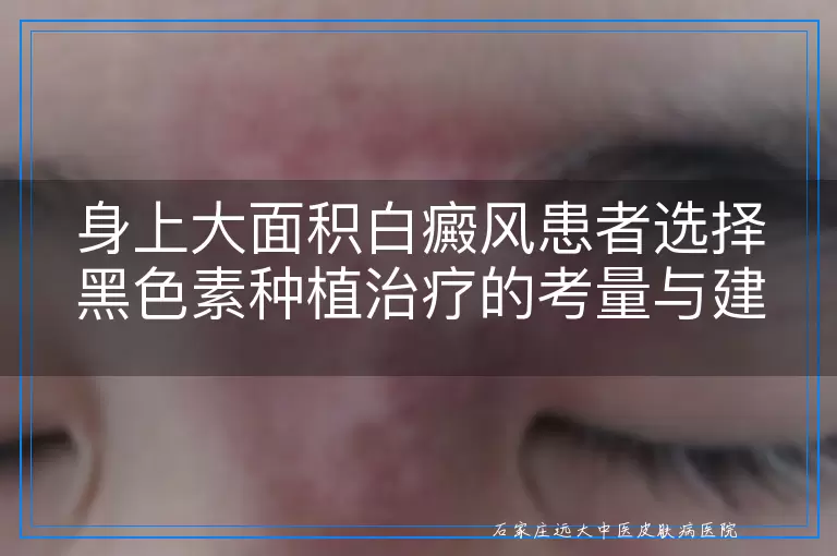 身上大面积白癜风患者选择黑色素种植治疗的考量与建议