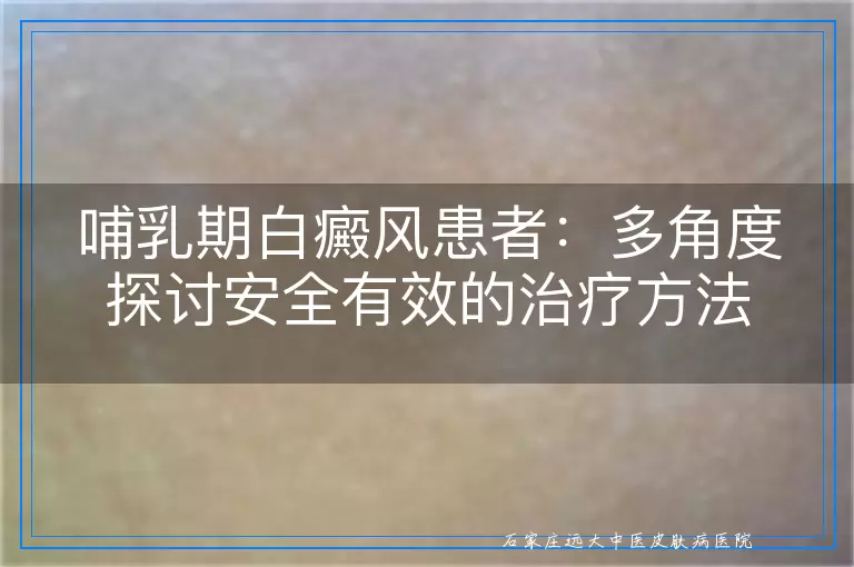哺乳期白癜风患者：多角度探讨安全有效的治疗方法