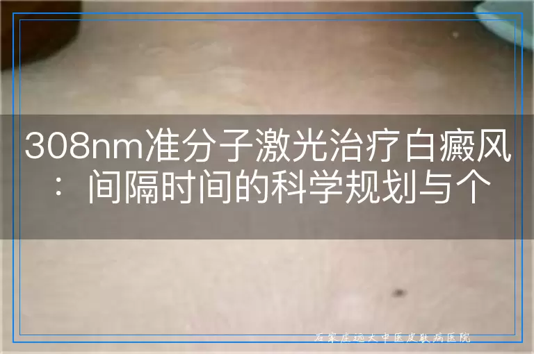 308nm准分子激光治疗白癜风：间隔时间的科学规划与个体考量